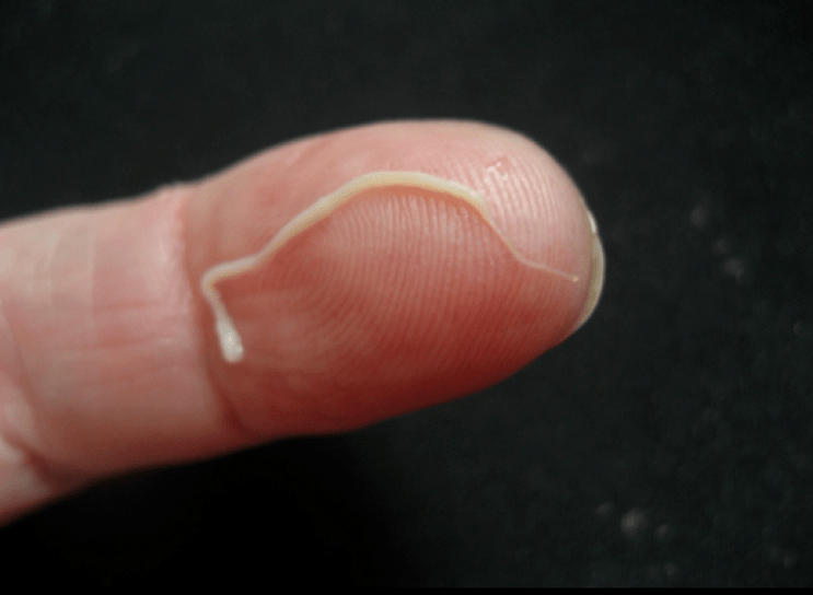 parazit škrkavky z lidského těla